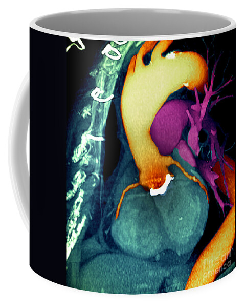 Aorta Coffee Mug featuring the photograph Prosthetic heart valve 3D CT Scan by Spl