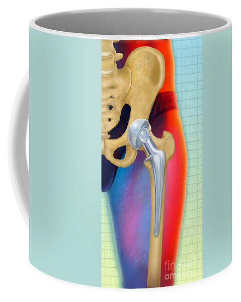 Science Coffee Mug featuring the photograph Prosthetic Hip Replacement by Chris Bjornberg