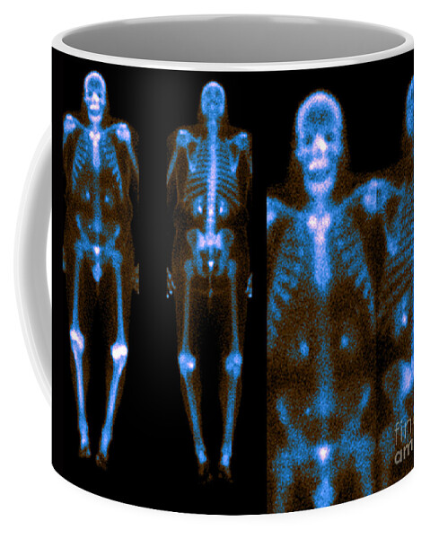 Bone Coffee Mug featuring the photograph Bone Scans #1 by Medical Body Scans