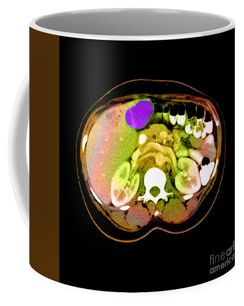 Abdomen Coffee Mug featuring the photograph Ct Scan Of A Liver Tumor #1 by Medical Body Scans