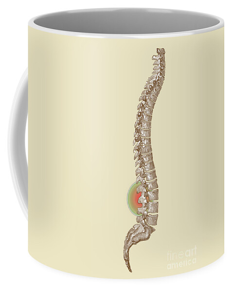Ache Coffee Mug featuring the photograph Lower Back Pain #1 by Science Source