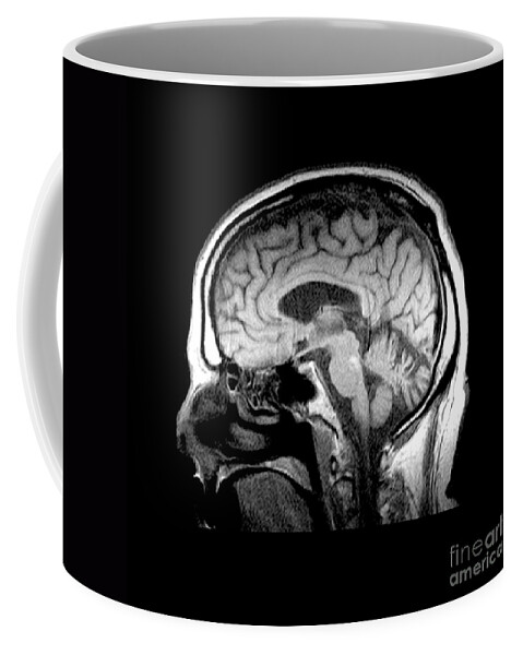 Mri Of Brain Coffee Mug featuring the photograph Mri Of Alcoholism Related Vermian #1 by Medical Body Scans