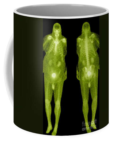 Obese Coffee Mug featuring the photograph Bone Scan #10 by Medical Body Scans
