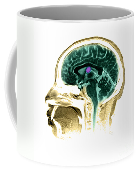 Anatomical Coffee Mug featuring the photograph Mri Colloid Cyst Of Third Ventricle #2 by Medical Body Scans