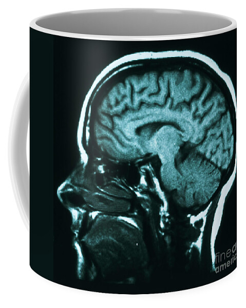Brain Coffee Mug featuring the photograph Mri Of Normal Brain #49 by Science Source