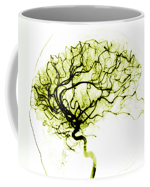 Catheter Cerebral Angiogram Coffee Mug featuring the photograph Cerebral Angiogram #3 by Medical Body Scans