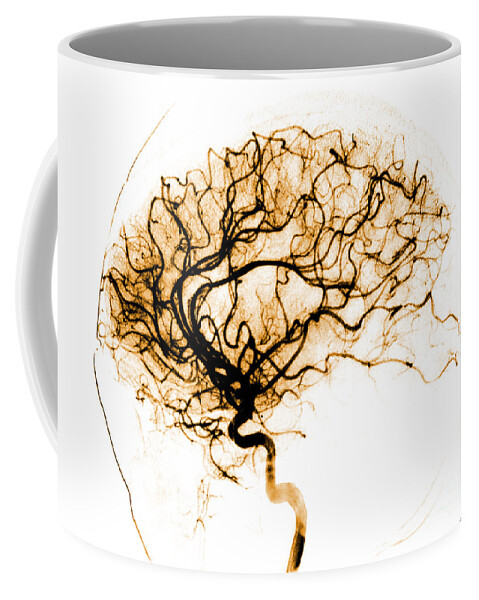 Catheter Cerebral Angiogram Coffee Mug featuring the photograph Cerebral Angiogram #4 by Medical Body Scans