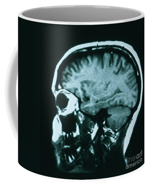 Brain Coffee Mug featuring the photograph Mri Of Normal Brain #4 by Science Source