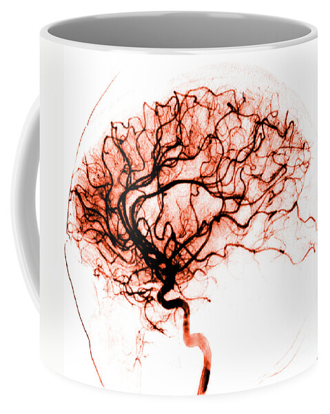 Catheter Cerebral Angiogram Coffee Mug featuring the photograph Cerebral Angiogram #5 by Medical Body Scans