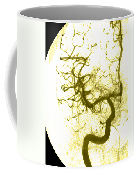 Angiogram Coffee Mug featuring the photograph Cerebral Angiogram #7 by Medical Body Scans