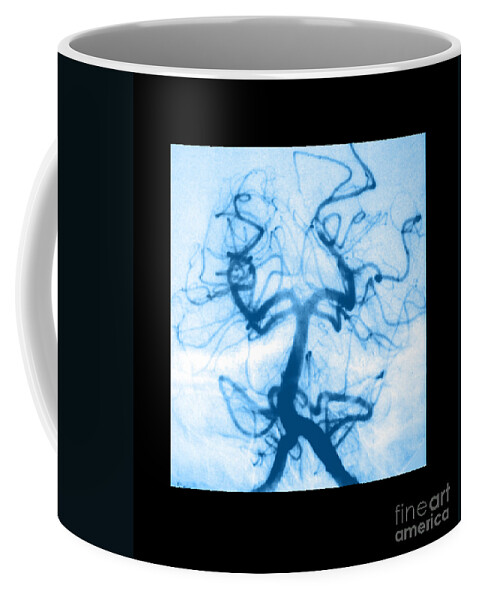 Abnormal Cerebral Angiogram Coffee Mug featuring the photograph Angiogram Of Embolus In Cerebral Artery by Medical Body Scans
