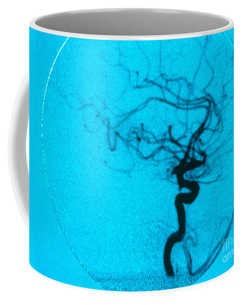Angiogram Coffee Mug featuring the photograph Cerebral Angiogram by Science Source