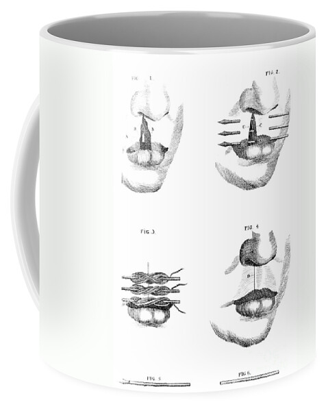 Medical Coffee Mug featuring the photograph Cleft Lip Surgery, 1791 by Science Source