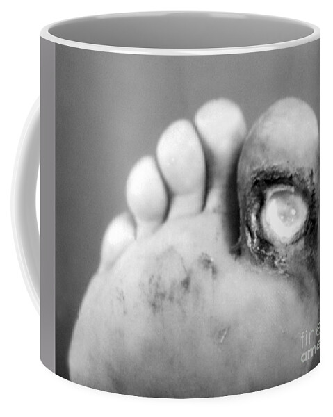 Bacterial Coffee Mug featuring the photograph Syphilis Ulcer by Science Source
