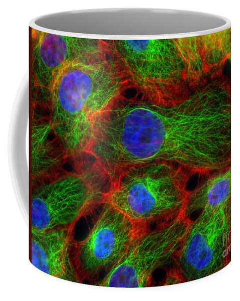 Science Coffee Mug featuring the photograph Breast Cancer Cells, Fm #6 by Science Source