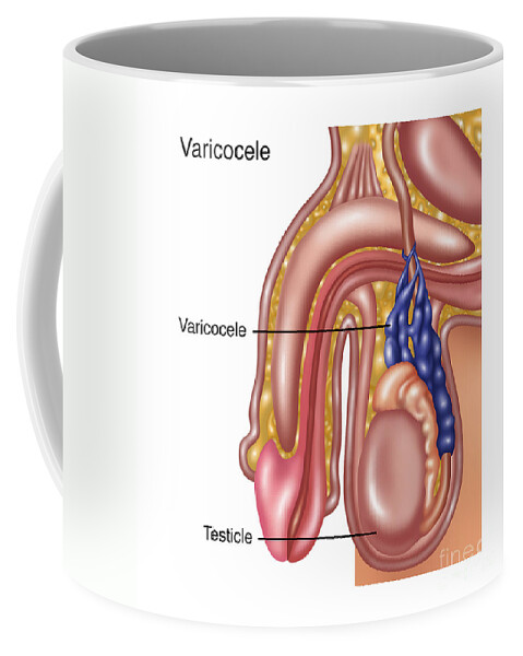 Medical Coffee Mug featuring the photograph Scrotal Varicocele, Illustration #1 by Gwen Shockey