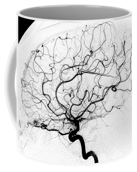 Cerebral Angiogram Coffee Mug featuring the photograph Dural Arterial Venous Fistula, Angiogram by Living Art Enterprises