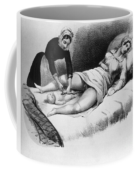 History Coffee Mug featuring the photograph Midwife Cutting Umbilical Cord, 1850 by Science Source