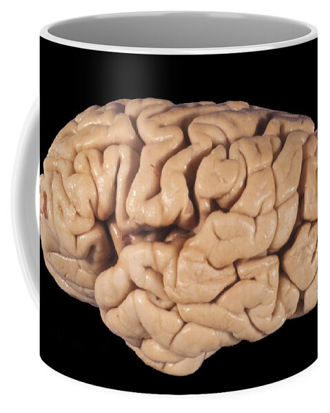 Abnormal Coffee Mug featuring the photograph Human Brain, Cortical Atrophy #1 by Jose Luis Calvo