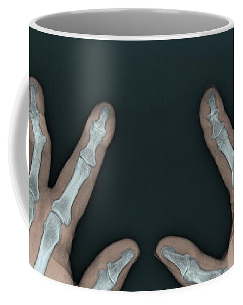 Abnormal Coffee Mug featuring the photograph Psoriatic Arthritis, X-ray #3 by Steven Needell