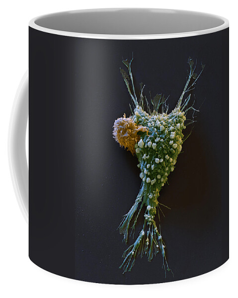 Adenocarcinoma Coffee Mug featuring the photograph Breast Cancer Cell With Car T-cell, Sem by Eye of Science