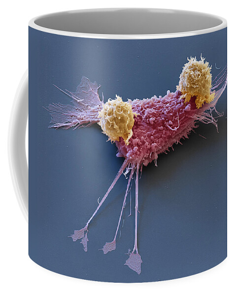 Adenocarcinoma Coffee Mug featuring the photograph Breast Cancer Cell With Car T-cells, Sem by Eye of Science