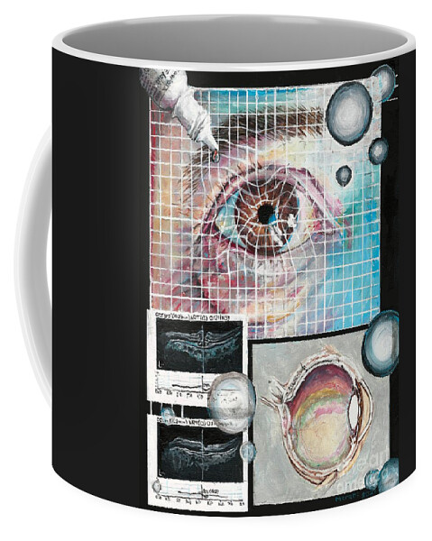 Eye Coffee Mug featuring the painting Macular Hole Repair by Merana Cadorette