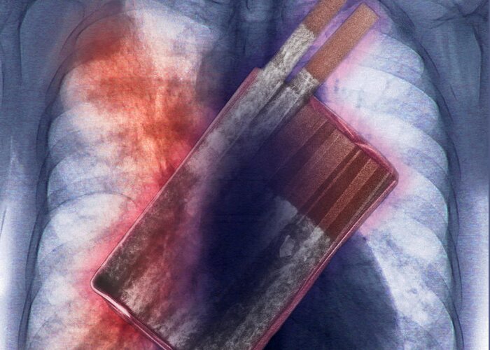 Illustration Greeting Card featuring the photograph Cigarettes And Lung Cancer #1 by Scott Camazine
