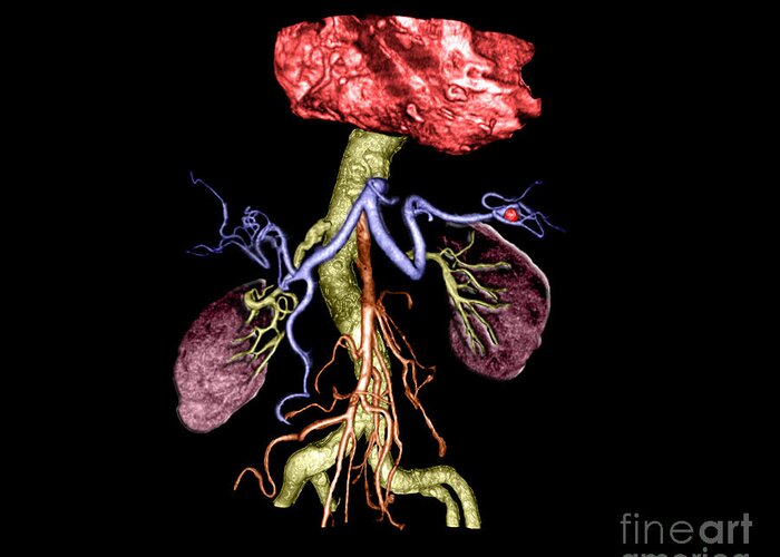 Computerized Axial Tomography Greeting Card featuring the photograph Splenic Artery Aneurysm #1 by Living Art Enterprises, LLC