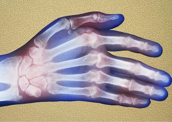 Arthritic Greeting Card featuring the photograph X-ray, Rheumatoid Arthritis #1 by Chris Bjornberg