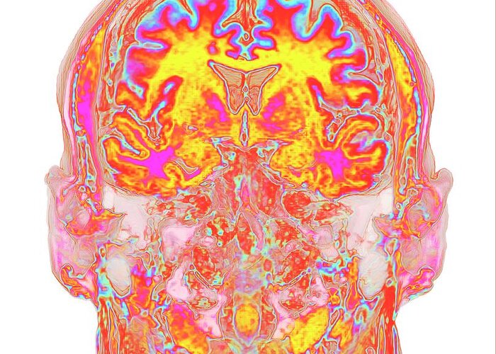 Organ Greeting Card featuring the photograph Human Head And Brain #10 by K H Fung/science Photo Library