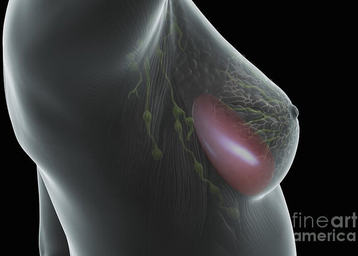 3d Visualisation Greeting Card featuring the photograph Breast Implant #2 by Science Picture Co
