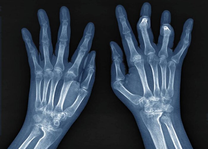 Rheumatoid Arthritis Greeting Card featuring the photograph Rheumatoid Arthritis Of The Hands #2 by Zephyr/science Photo Library