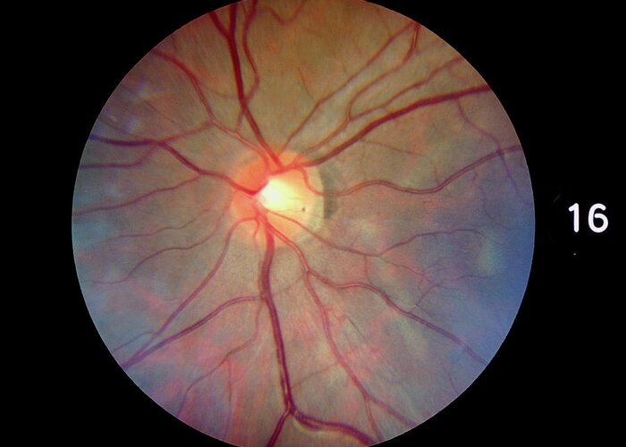 Fundoscopy Greeting Card featuring the photograph Fundus Camera Image Of A Normal Retina #4 by Rory Mcclenaghan/science Photo Library