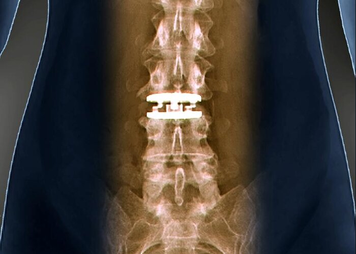 Prosthesis Greeting Card featuring the photograph Artificial Spinal Disc, X-ray by Zephyr