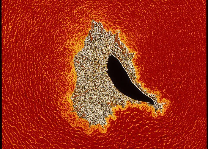 Magnified Image Greeting Card featuring the photograph Atherosclerosis by Pasieka