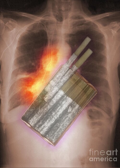 Illustration Greeting Card featuring the photograph Cigarettes And Lung Cancer by Scott Camazine