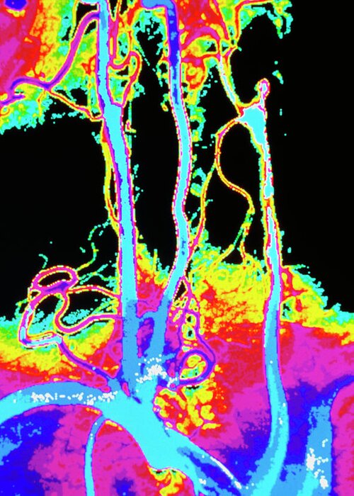 Angiogram Greeting Card featuring the photograph Colour Angiogram Of Arteries In The Human Neck by Gca/science Photo Library
