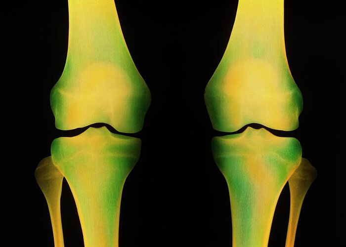 Knee Joint Greeting Card featuring the photograph Coloured X-ray Of Healthy Knee Joints by Science Photo Library