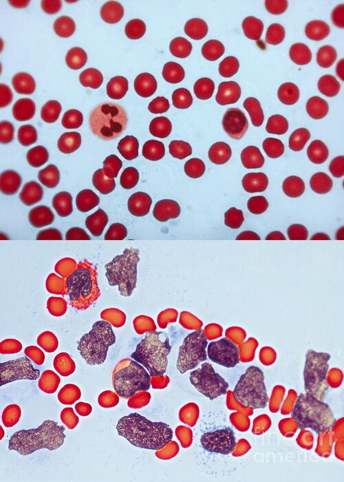 Blood Cell Greeting Card featuring the photograph Healthy Leukemia Blood Comparison by Spencer Sutton