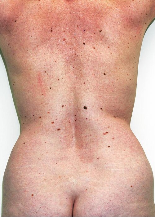 Human Greeting Card featuring the photograph Moles On A Woman's Back by Dr M.a. Ansary/science Photo Library