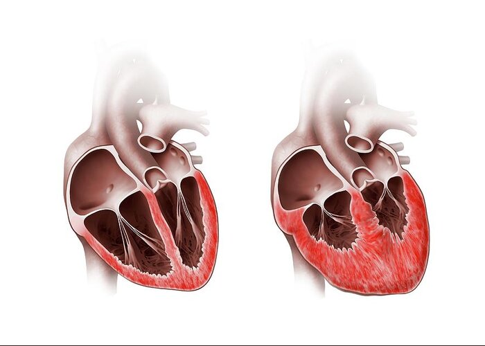 Heart Greeting Card featuring the photograph Normal And Enlarged Hearts by Henning Dalhoff / Science Photo Library