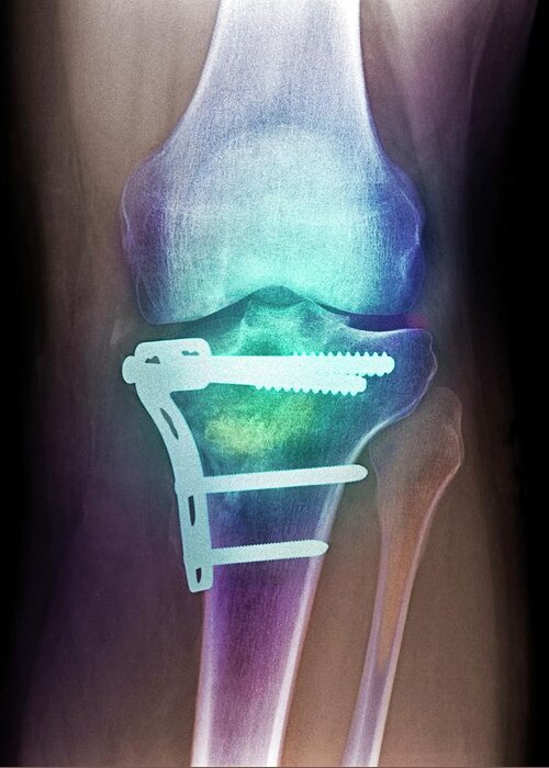 Bone Greeting Card featuring the photograph Pinned Broken Knee by Science Photo Library