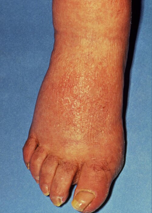 Syphilis Greeting Card featuring the photograph Rash & Swelling On Foot Due To Secondary Syphilis by Science Photo Library