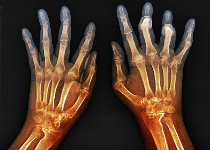 Rheumatoid Arthritis Greeting Card featuring the photograph Rheumatoid Arthritis Of The Hands by Zephyr/science Photo Library