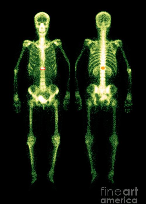 Acute Compression Fracture Greeting Card featuring the photograph Bone Scan #1 by Medical Body Scans