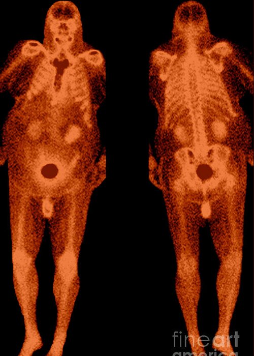 Obese Greeting Card featuring the photograph Bone Scans #2 by Medical Body Scans