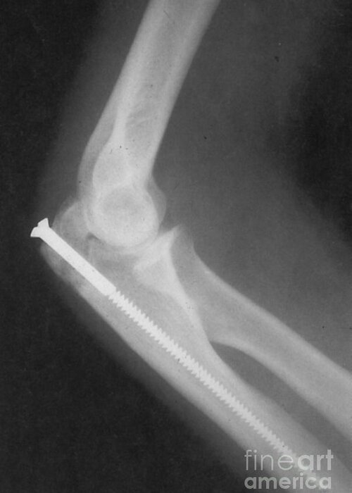 Science Greeting Card featuring the photograph Broken Arm With Metal Pin, X-ray #2 by Science Source