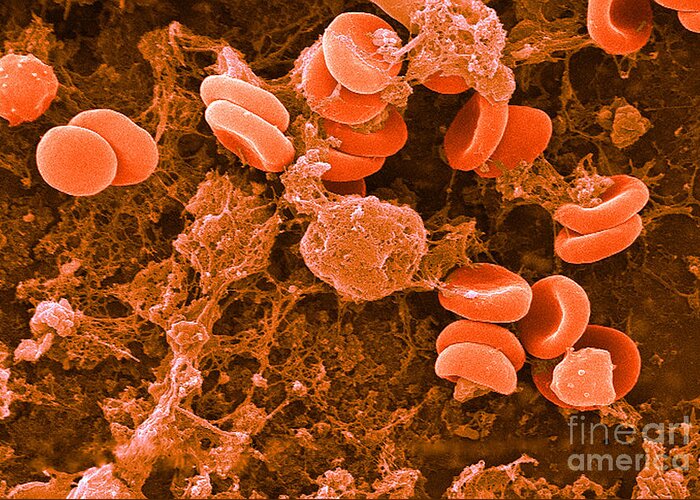Biology Greeting Card featuring the photograph Red Blood Cells, Rouleaux Formation, Sem #2 by Science Source