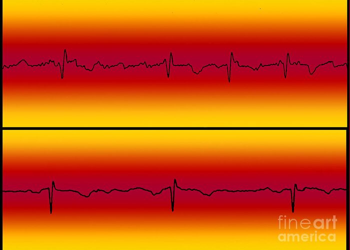 Atrial Flutter Greeting Card featuring the photograph Atrial Flutter and Normal Heart Beat by Science Source